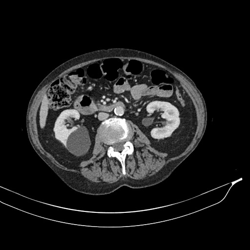 Calcified adrenal glands and Spigelian hernia (Radiopaedia 49741-54988 A 101).jpg