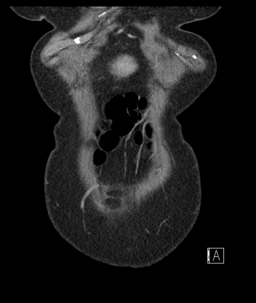 Calcified adrenal glands and Spigelian hernia (Radiopaedia 49741-54988 B 11).jpg