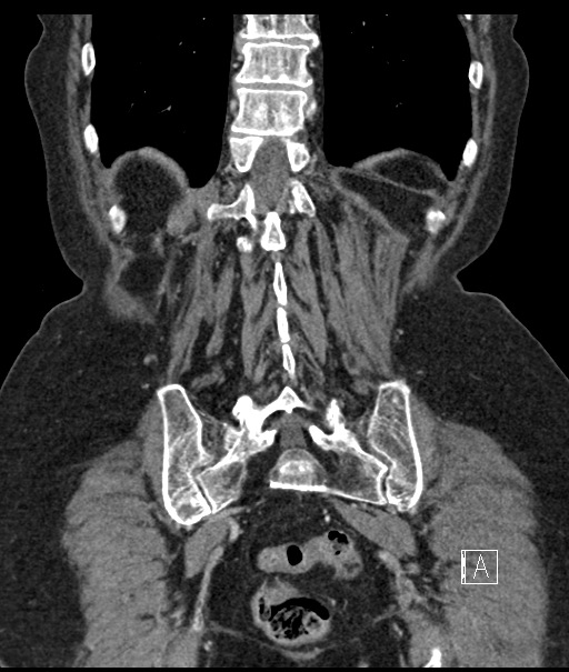 Calcified adrenal glands and Spigelian hernia (Radiopaedia 49741-54988 B 95).jpg