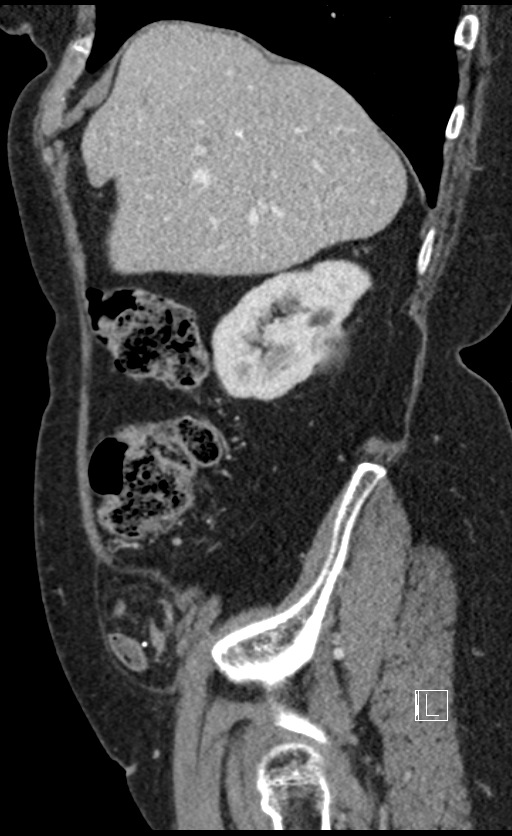 Calcified adrenal glands and Spigelian hernia (Radiopaedia 49741-54988 C 126).jpg