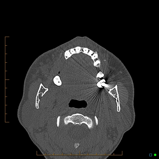 Calcified facial augmentation fillers (Radiopaedia 79514-92679 Axial bone window 90).jpg