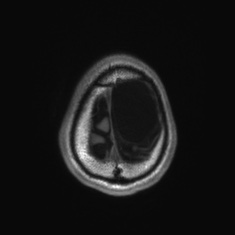 Callosal dysgenesis with interhemispheric cyst (Radiopaedia 53355-59335 Axial T1 145).jpg