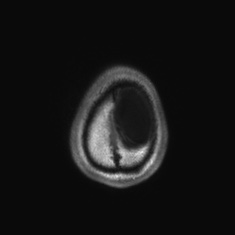 Callosal dysgenesis with interhemispheric cyst (Radiopaedia 53355-59335 Axial T1 151).jpg