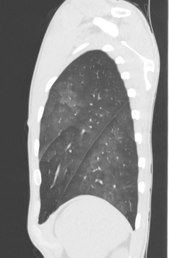 Cannabis-induced diffuse alveolar hemorrhage (Radiopaedia 89834-106946 Sagittal lung window 119).jpg