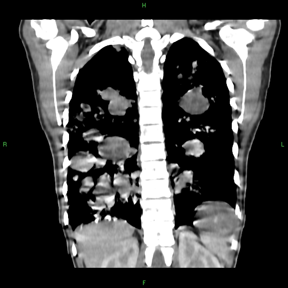 File:Cannon ball metastases - synovial sarcoma (Radiopaedia 26135-26271 Coronal liver window 16).jpg