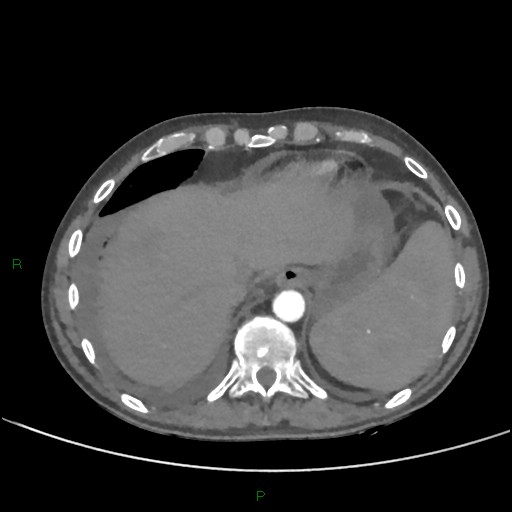 Cannonball metastases (Radiopaedia 82110-96150 Axial C+ CTPA 268).jpg