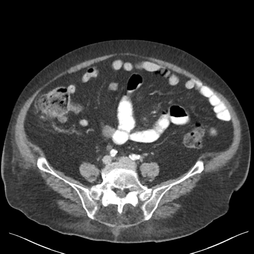 Cannonball metastases from endometrial cancer (Radiopaedia 42003-45031 E 51).png