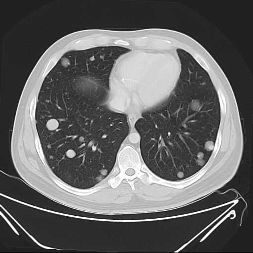 File:Cannonball pulmonary metastases (Radiopaedia 67684-77101 B 18).jpg