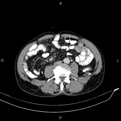 File:Caput medusae sign - portal hypertension (Radiopaedia 64007-72759 A 57).jpg