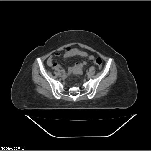 Carcinoma cervix- brachytherapy applicator (Radiopaedia 33135-34173 Axial non-contrast 13).jpg
