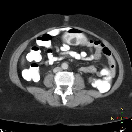File:Carcinoma of sigmoid colon (Radiopaedia 23071-23100 B 11).jpg