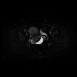Carcinoma of the cervix (Radiopaedia 89018-105858 Axial DWI 14).jpg