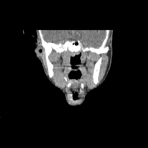 Carcinoma of the maxillary antrum (Radiopaedia 53805-59888 Coronal C+ delayed 81).jpg