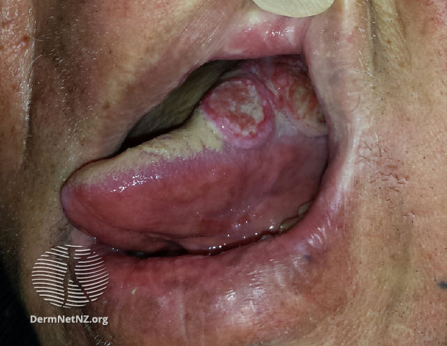 File:Carcinoma of the tongue (DermNet NZ oral-cancer).jpg