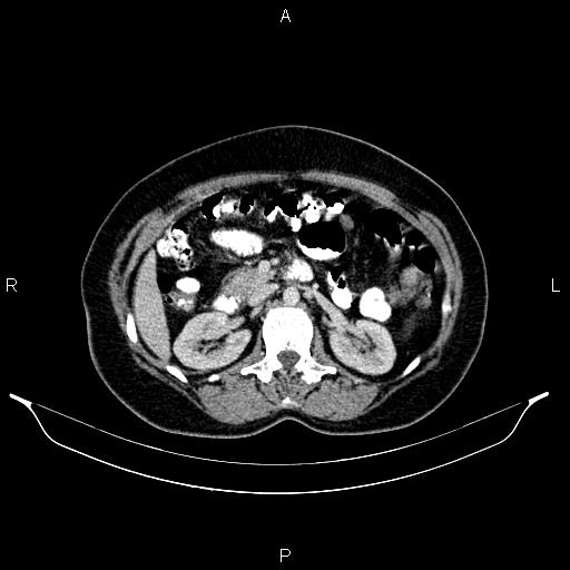 Carcinoma of uterine cervix (Radiopaedia 85861-101700 A 43).jpg