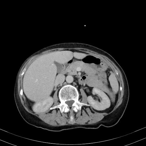 Carcinosarcoma (Radiopaedia 70401-80503 A 24).jpg