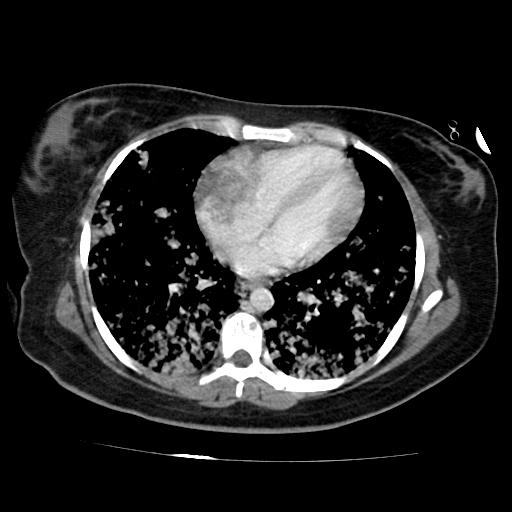 File:Cardiac angiosarcoma (Radiopaedia 66010-75181 B 105).jpg