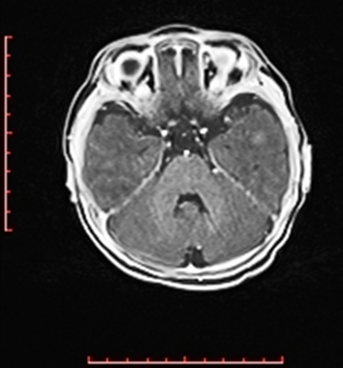 Cardiac rhabdomyoma - tuberous sclerosis (Radiopaedia 70089-80114 Axial T1 C+ fat sat 15).jpg