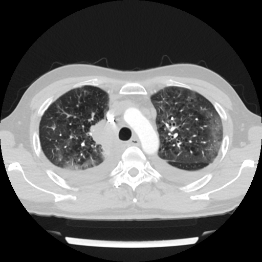 Cardiac tamponade (Radiopaedia 78607-91368 Axial lung window 19).jpg