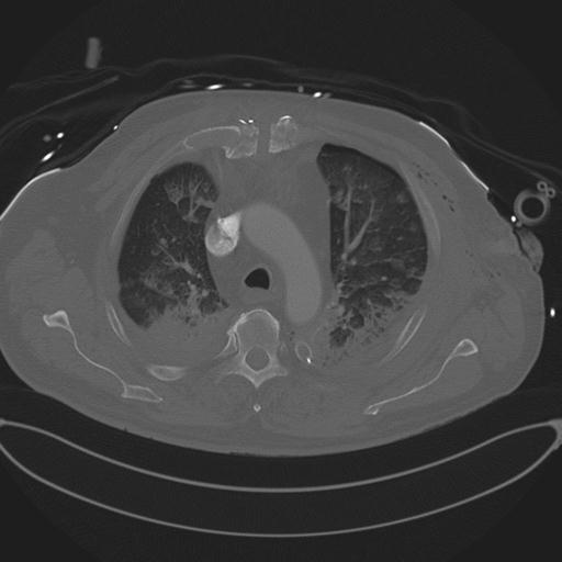 Cardiac trauma (Radiopaedia 32874-33858 Axial bone window 27).jpg