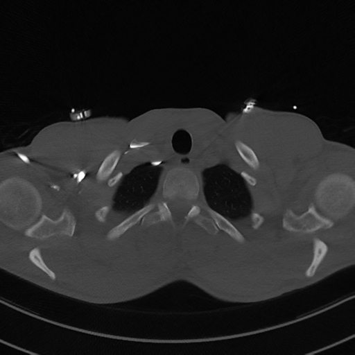 Cardiac tumor - undifferentiated pleomorphic sarcoma (Radiopaedia 45844-50134 Axial bone window 6).png