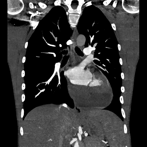 Cardiac tumor - undifferentiated pleomorphic sarcoma (Radiopaedia 45844-50134 Coronal non-contrast 38).png