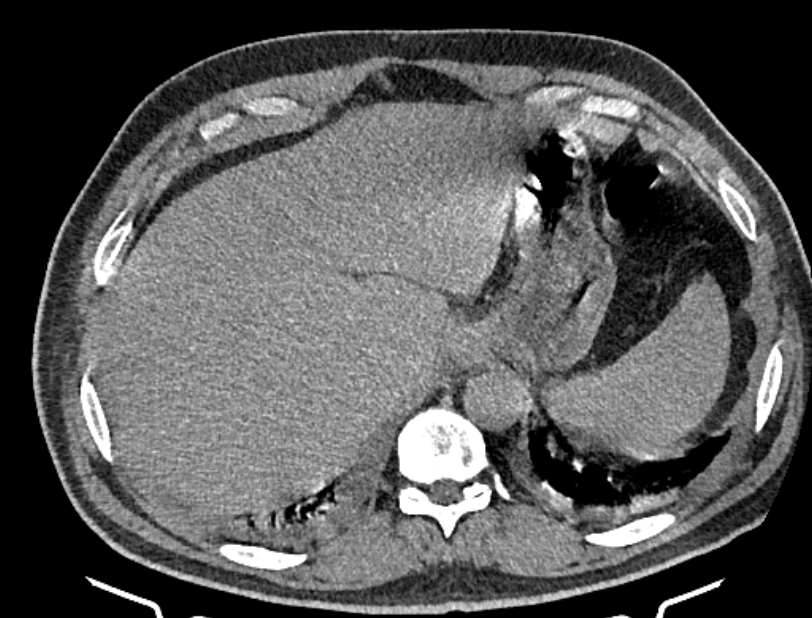 Cardiogenic pulmonary edema (Radiopaedia 68180-77678 Axial non-contrast 51).jpg