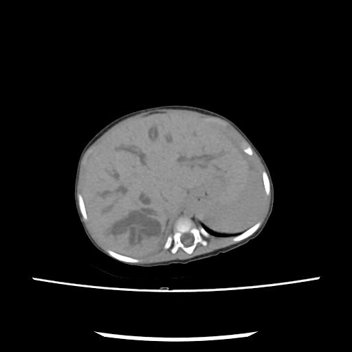 Caroli disease with autosomal recessive polycystic kidney disease (ARPKD) (Radiopaedia 89651-106703 E 43).jpg