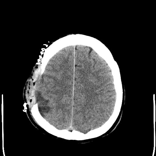 File:Carotid arterial dissection (Radiopaedia 30001-30548 Axial non-contrast 23).jpg