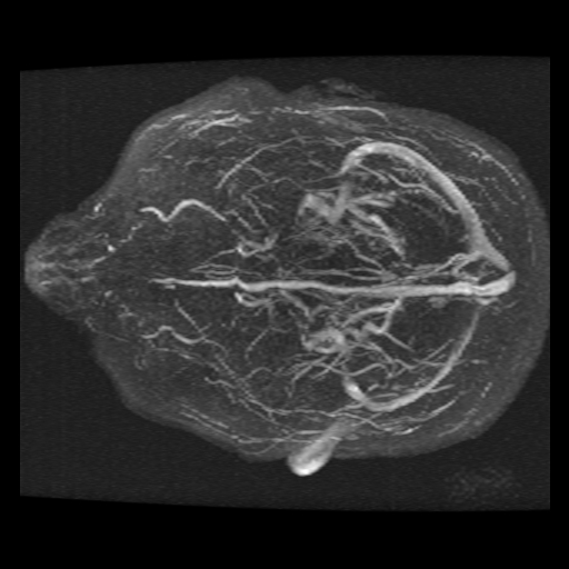 Carotid arterial dissection with acute cerebral infarction (Radiopaedia 26636-26784 MRV 11).jpg