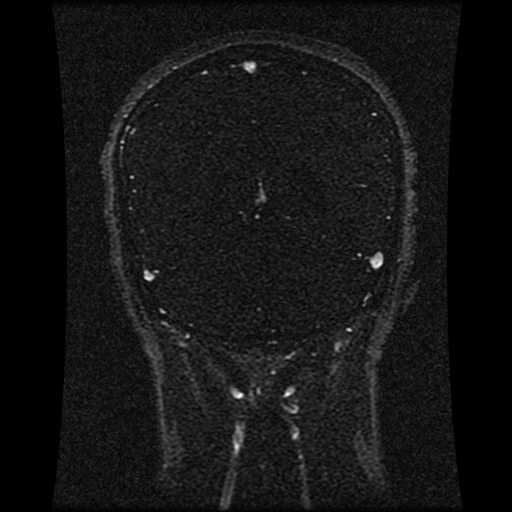 Carotid arterial dissection with acute cerebral infarction (Radiopaedia 26636-26784 MRV 67).jpg