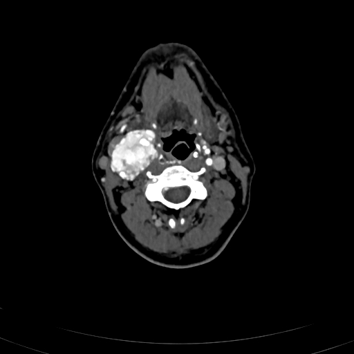 Carotid body tumor (Radiopaedia 83615-98727 A 56).jpg