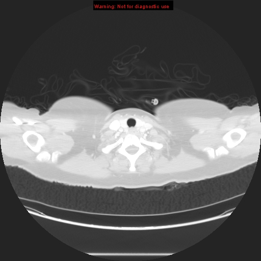 Carotid body tumor with lung metastases (Radiopaedia 9301-48390 Axial lung window 8).jpg