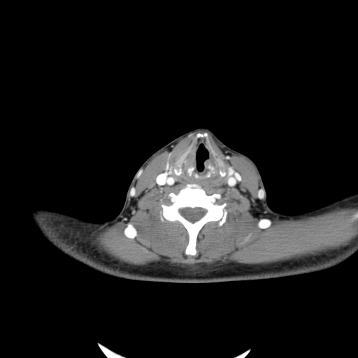 Carotid bulb pseudoaneurysm (Radiopaedia 57670-64616 A 49).jpg
