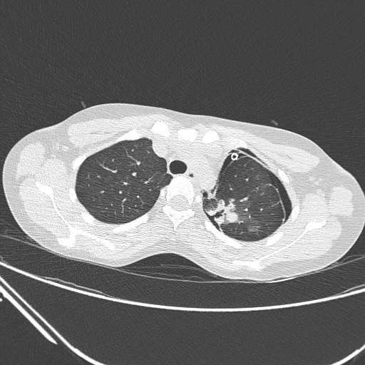 Catamenial pneumothorax (Radiopaedia 27946-28197 lung window 45).jpg