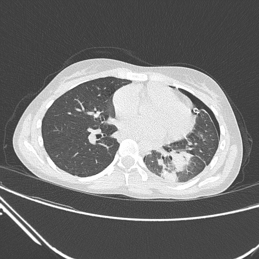 Catamenial pneumothorax (Radiopaedia 27946-28197 lung window 94).jpg