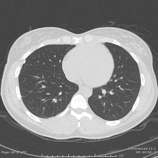 Catamenial pneumothorax (Radiopaedia 54382-60600 Axial non-contrast 60).jpg