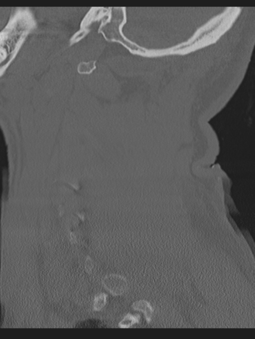 Cavernoma of cervical cord (Radiopaedia 50838-56346 Sagittal bone window 65).png