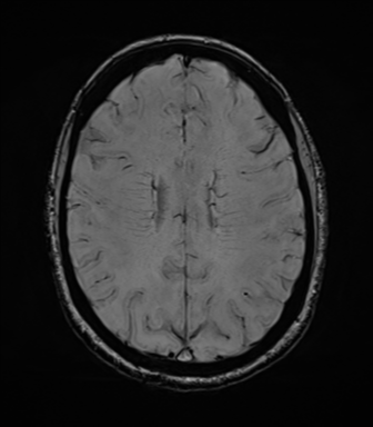File:Cavernoma with bleed - midbrain (Radiopaedia 54546-60773 Axial SWI 32).png