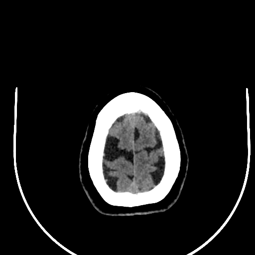 Cavernous hemangioma of the cerebellar falx (Radiopaedia 73025-83723 Axial non-contrast 127).jpg