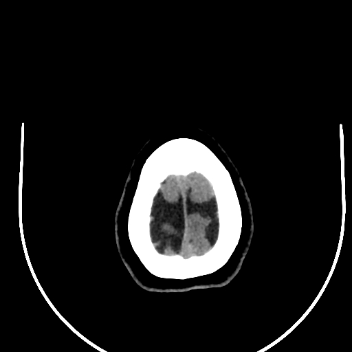 Cavernous hemangioma of the cerebellar falx (Radiopaedia 73025-83723 Axial non-contrast 131).jpg