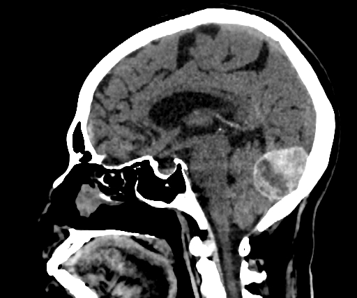 Cavernous hemangioma of the cerebellar falx (Radiopaedia 73025-83723 B 172).jpg