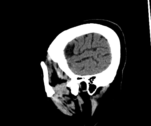 Cavernous hemangioma of the cerebellar falx (Radiopaedia 73025-83723 B 285).jpg