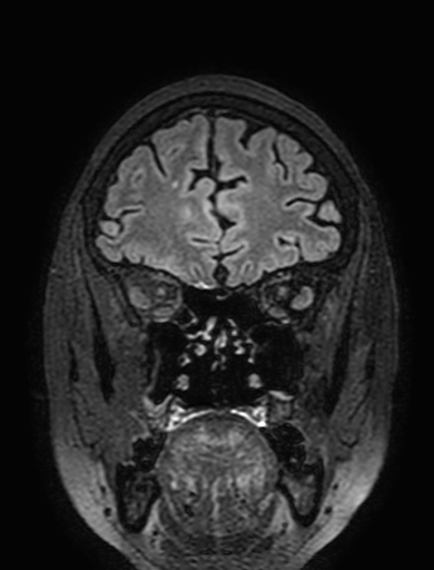 Cavernous hemangioma of the cerebellar falx (Radiopaedia 73025-83724 Coronal FLAIR 73).jpg