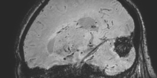 Cavernous hemangioma of the cerebellar falx (Radiopaedia 73025-83724 Sagittal BOLD 128).jpg