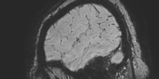 File:Cavernous hemangioma of the cerebellar falx (Radiopaedia 73025-83724 Sagittal BOLD 27).jpg