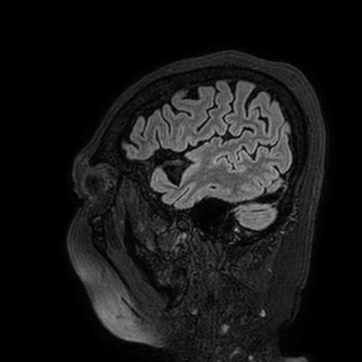 Cavernous hemangioma of the cerebellar falx (Radiopaedia 73025-83724 Sagittal FLAIR 26).jpg