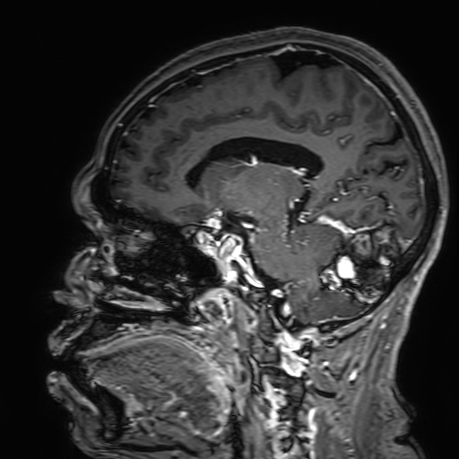Cavernous hemangioma of the cerebellar falx (Radiopaedia 73025-83724 Sagittal T1 C+ 124).jpg