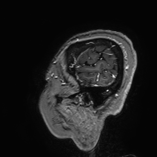 Cavernous hemangioma of the cerebellar falx (Radiopaedia 73025-83724 Sagittal T1 C+ 193).jpg