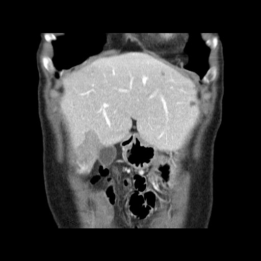 Cavernous hepatic hemangioma (Radiopaedia 75441-86667 C 30).jpg